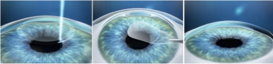 smile 手术过程示意图.